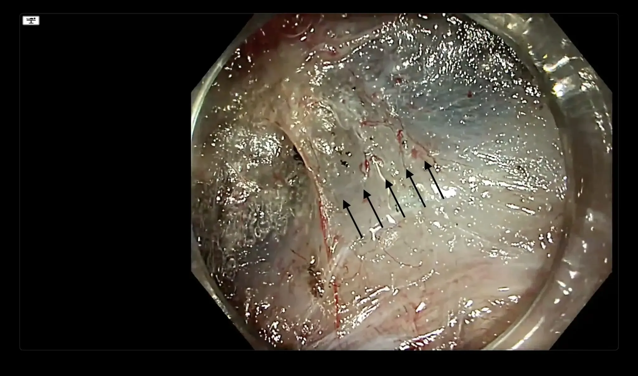 Image of an Endoscopy